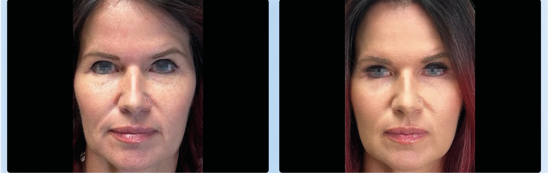 Manufacturer-provided facial rejuvenation comparison, before on the left and after on the right